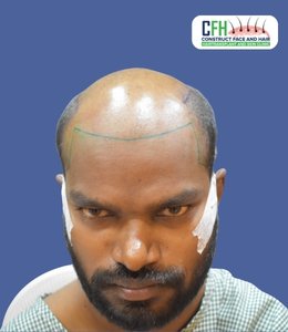 Hair Transplant Before - Case 08