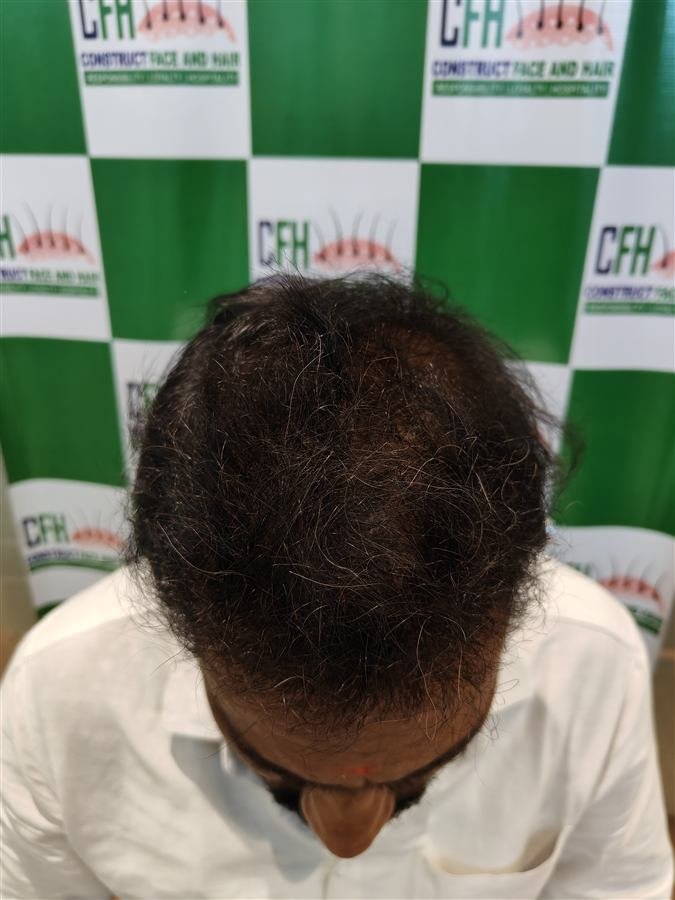 CFH hair transplant patient result