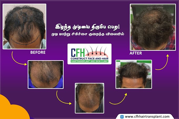 Myths About Hair Transplants and the Truth Behind Them: Insights from CFH Hair Transplant Centre, Chennai