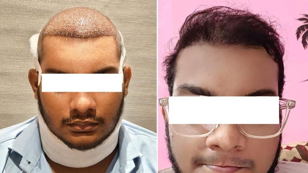 Myths About Hair Transplants and the Truth Behind Them: Insights from CFH Hair Transplant Centre, Chennai