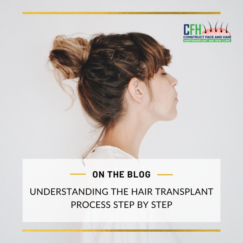 Understanding the Hair Transplant Process Step-by-Step: A Guide from CFH Hair Transplant Centre, Chennai