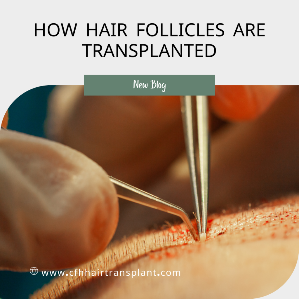 The Science of Hair Grafting: How Hair Follicles Are Transplanted