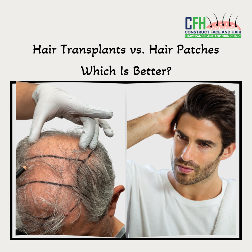 Hair Transplants vs. Hair Patches: Which Is Better?