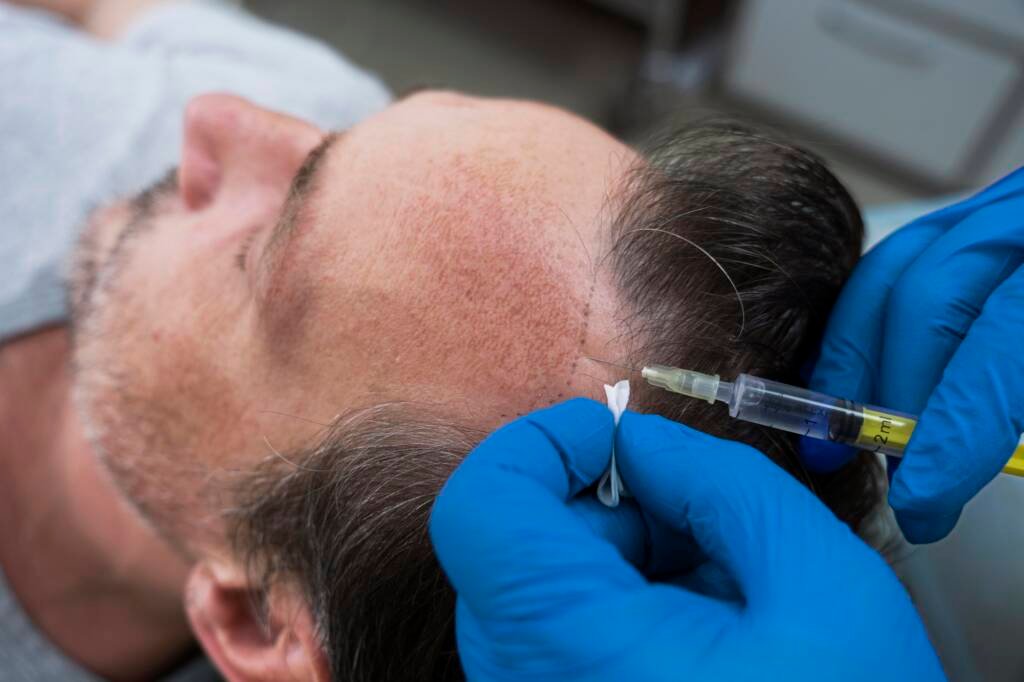 Affordable GFC Hair Treatment Cost in Chennai for Hair Regrowth