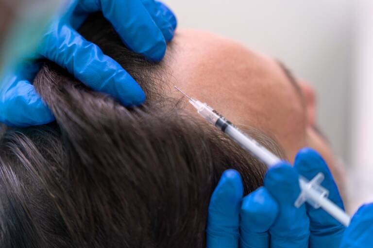 What is PRP Treatment for Hair? Everything You Need to Know