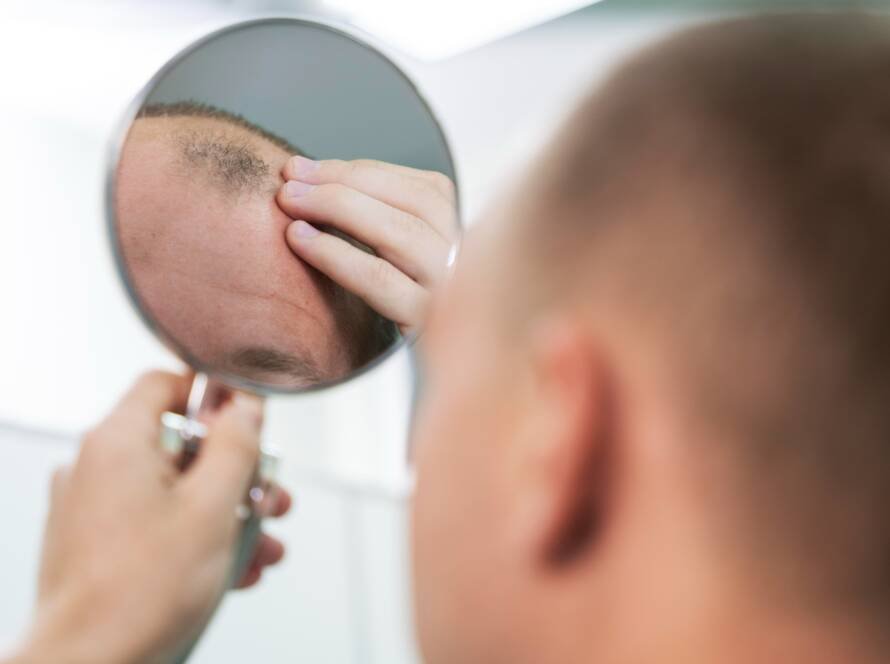 Dermatologist at CFH Skin & Hair Clinic in Chennai explaining why transplanted hair is permanent but natural hair may still thin over time.