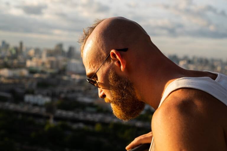 How Long After a Hair Transplant Can I Go in the Sun