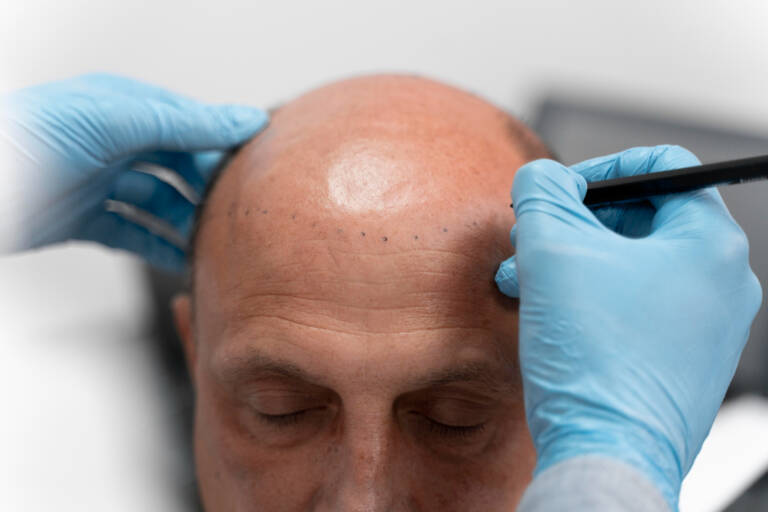Sapphire FUE Explained: Why Gemstone Blades Mean Faster Healing