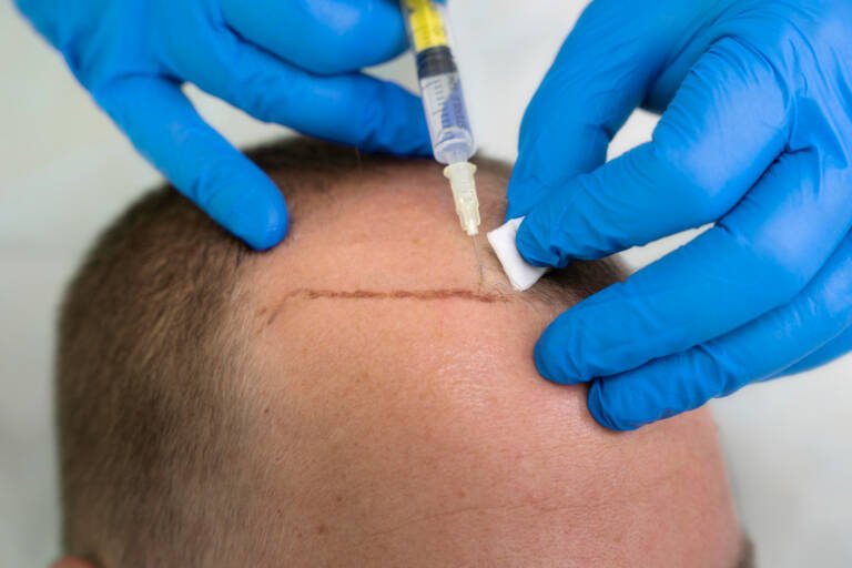 The Real Cost of a Hair Transplant in Chennai 2026: Is It Worth the Investment?