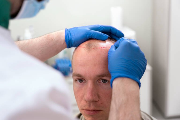 Hair Transplant Is Good or Bad? Honest Medical Explanation
