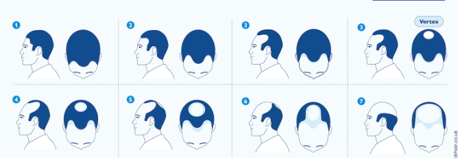 Norwood Scale
