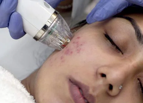 Skin Whitening Glutathione Treatment in Chennai | CFH Clinic