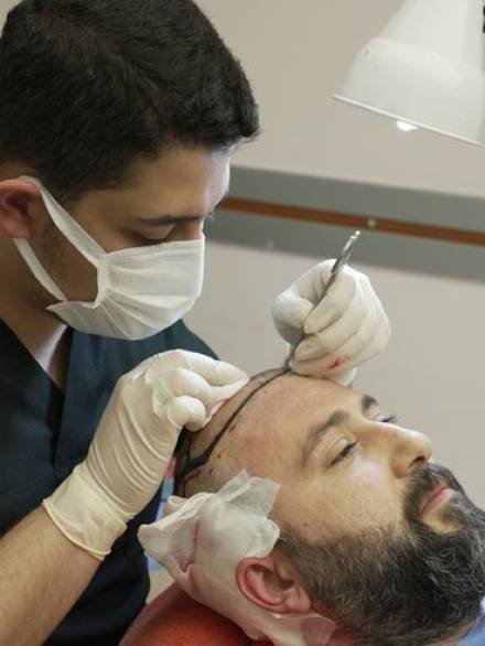 hair transplant in Abiramipuram